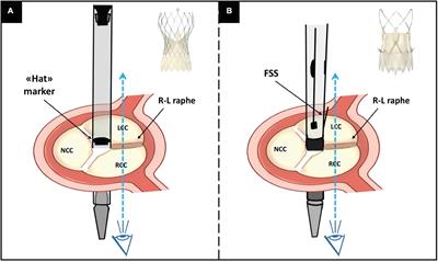 Definition of trAnscatheter heart Valve orIeNtation in biCuspId aortic valve: The DA VINCI pilot study